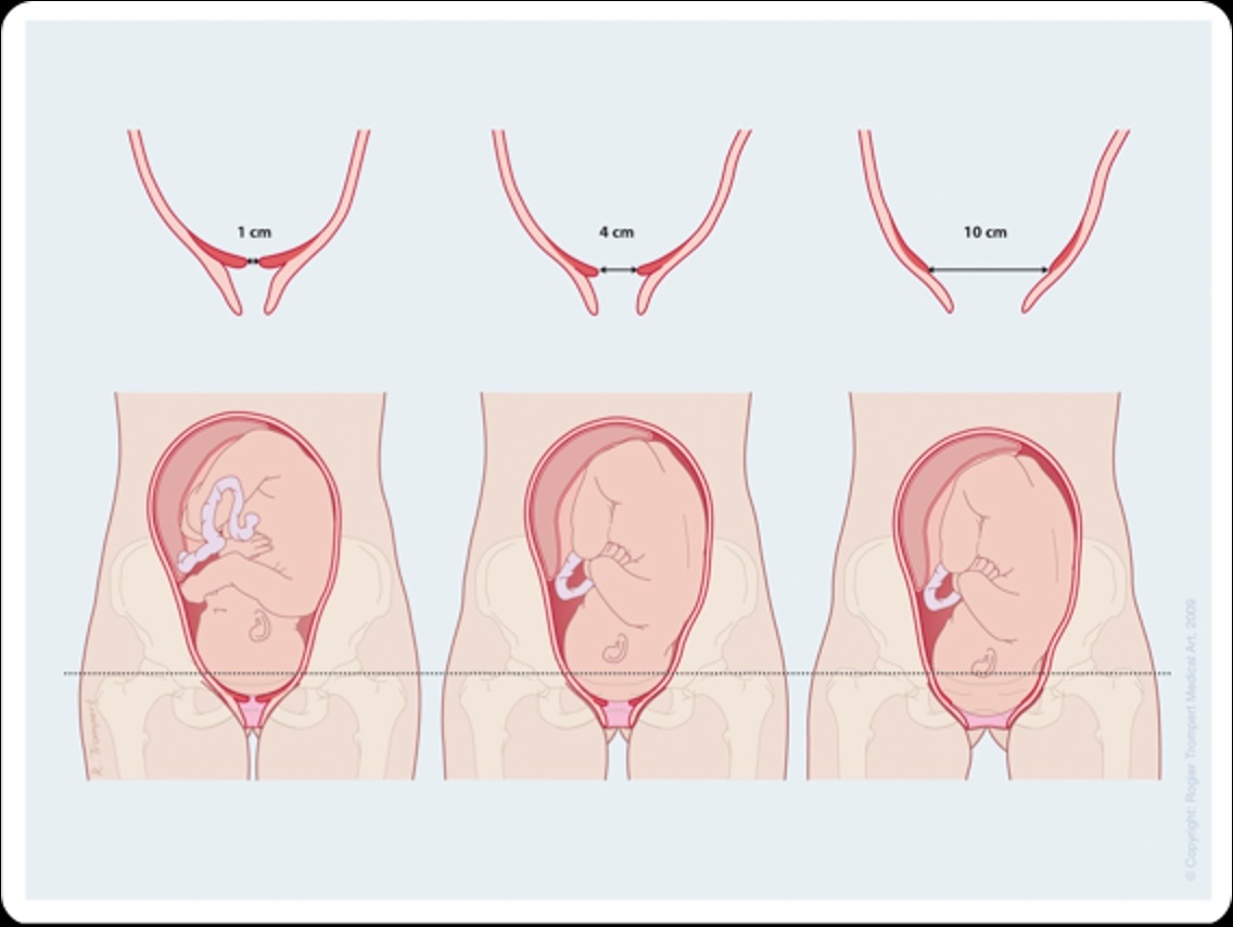 Tekening van ontsluiten van de baarmoeder