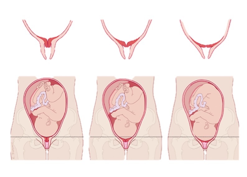 Uitleg over verstrijken van de baarmoeder